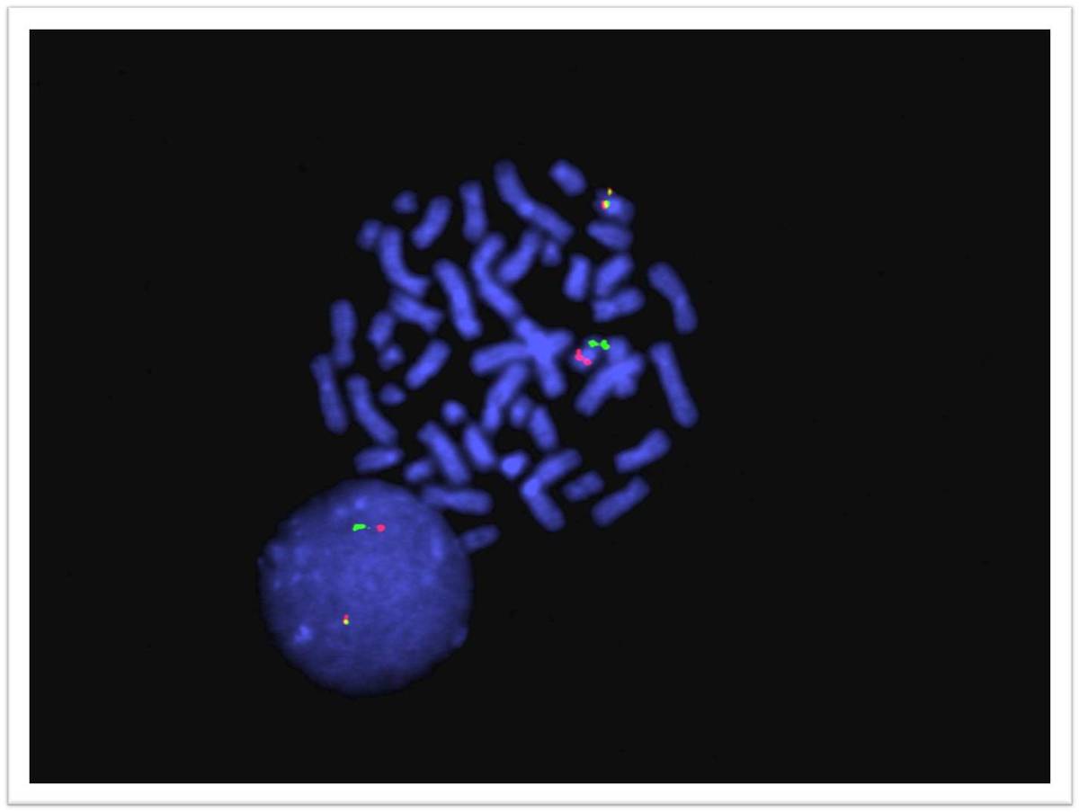 Fluorescence in situ hybridization demonstrating 1 red signal (CBFB probe), 1 green signal (MYH11 probe) and one fusion signal